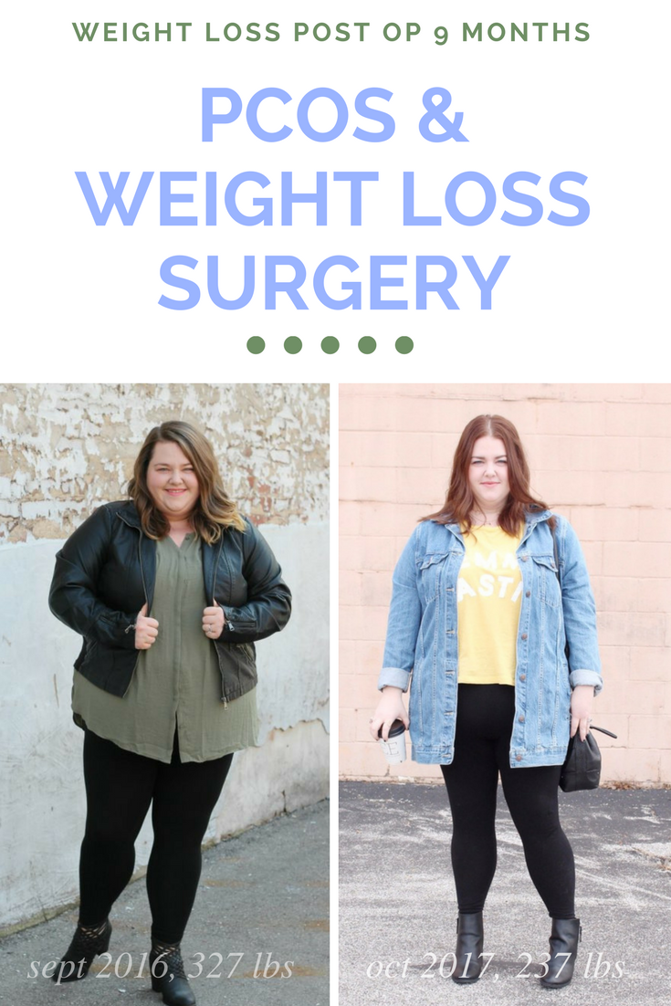 Pcos Weight Loss Surgery Blog Dandk pcos-weight-loss-surgery-blog-dandk